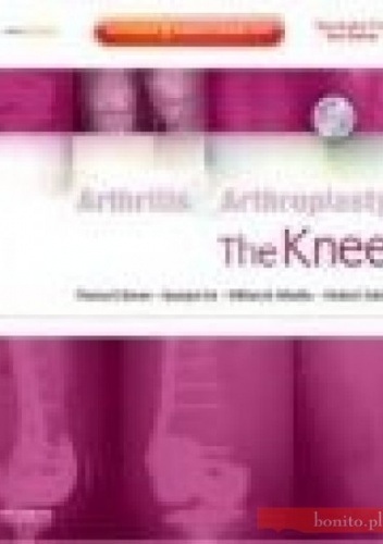 Arthritis and Arthroplasty The Knee