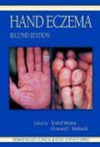 Hand Eczema - Trokil Menne
