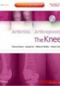 Arthritis and Arthroplasty The Knee