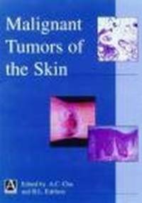 Malignant Tumors of Skin - A. Chu